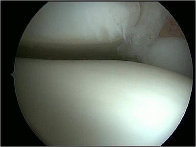 Bild zeigt Arthroskopie des oberen Sprunggelenks. Normaler Gelenkbefund.