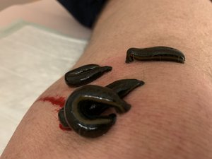 Bild zeigt Blutegel auf einem Arm