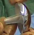 Bild zeigt eine Kappenprothese für die Schulter - auch Cup oder Oberflächenersatz genannt. Damit wird der verschlissene Oberarmkopf überkleidet.