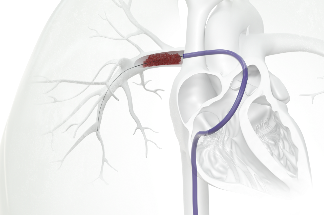 Behandlung schwerer Lungenembolien mittels Thrombektomie
